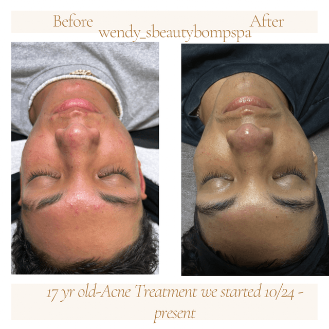 Acne clearing package at Wendy’s Beauty bomb Spa in Chino, CA